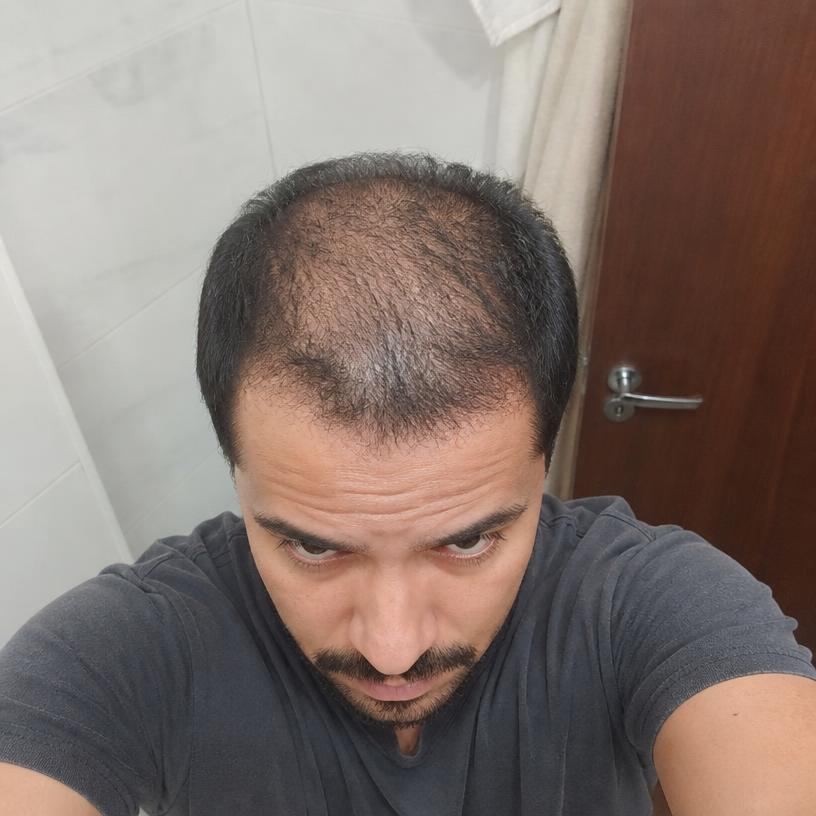 Antes — Rafael, 34 — SP