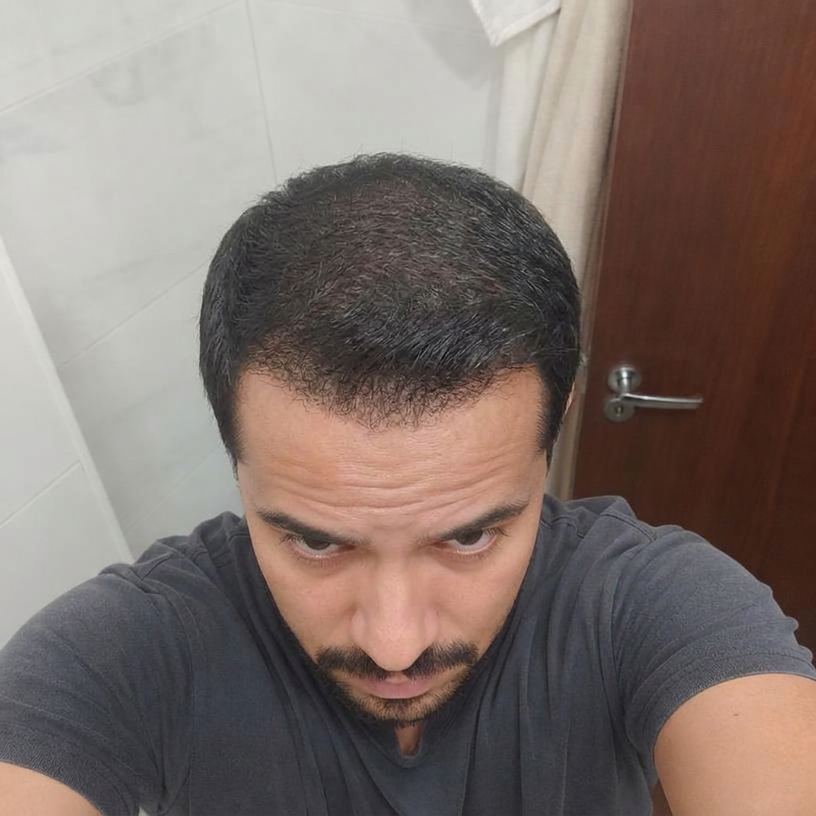 Depois — Rafael, 34 — SP